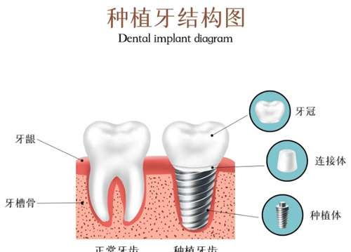 种植牙价格贵吗？种植牙后维持几年？