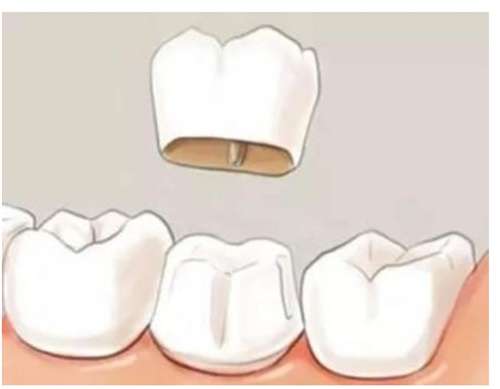 烤瓷假牙的使用寿命是多久？术后注意事项