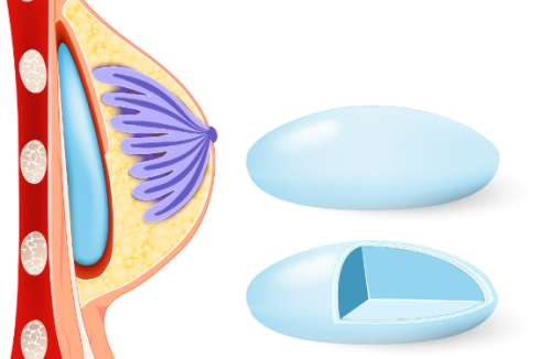 艾斯美假体和傲诺拉哪个好？纠结选哪个？内行人实测干货全揭秘