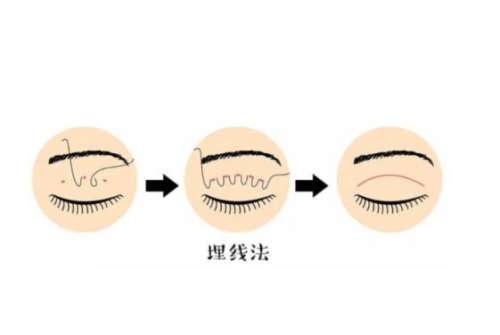 埋线双眼皮2.jpg