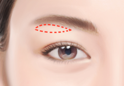 提眉手术一般要多少钱？影响价格的因素有哪些