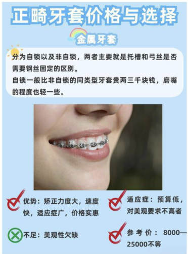 北京中诺牙套价格表:技术同源+耗材透明,不玩猫腻