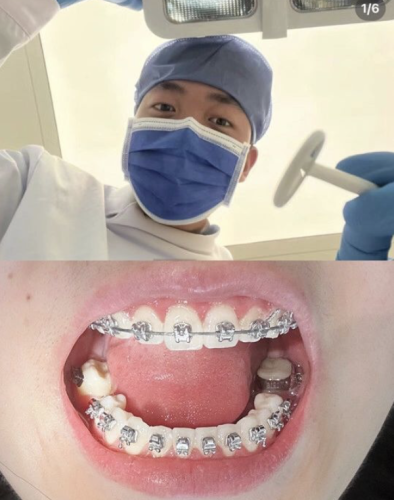 安医二附院牙齿正畸怎么样？3个真实案例+2份数据表，揭秘三甲正畸硬核实力