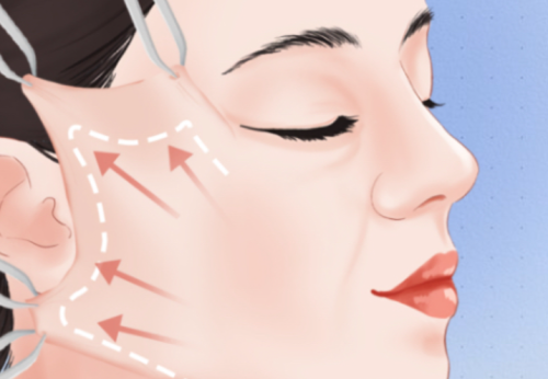 五层提升手术多少钱？手术费、麻醉费、耗材费分别是多少？