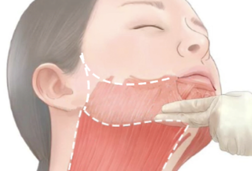 劲阔肌提升需要多少单位？面型不同用量差别非常大