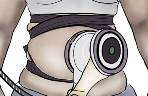 仪器吸脂会反弹吗？什么情况容易显得“反弹”，哪些是错觉？