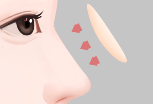 垫鼻梁用哪里的软骨好？材料优缺点＋恢复难度一次讲透