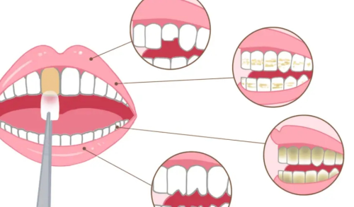 潍坊阳光牙齿贴面多少钱？不同档次方案费用详细说明