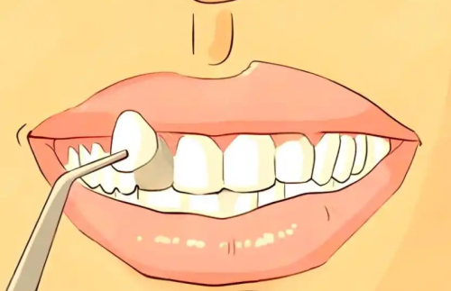 南京美奥牙齿贴面多少钱？从咨询到完成，每个环节的收费说明