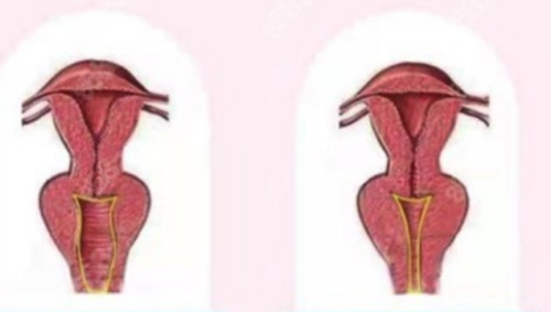 紧缩术需要多少钱?手术费、耗材费、复诊费一并算清楚