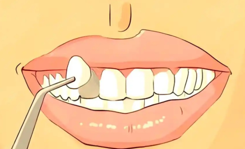 苏州市立医院做牙贴面多少钱？附单颗到全口的费用对比