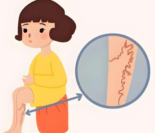 怎样去除腿上的红血丝？产生原因+去除方法了解，春夏露腿无压力