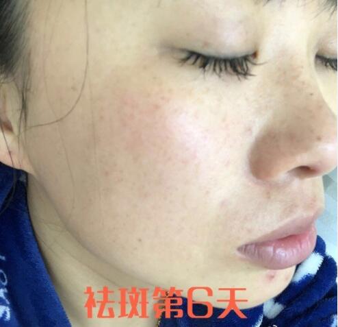 蚌埠祛斑体验日记