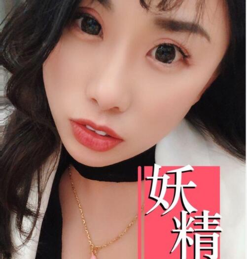 蚌埠祛斑激光术后果图