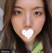 韩式三点定位双眼皮体验日记分享！现在就要美，看我果图！