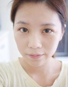 伊维兰注射隆鼻果好不好？真实体验日记分享俏丽美鼻的诞生！