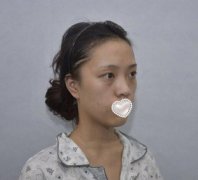自体脂肪填充下眼睑，让眼部重焕光彩！我的手术体验日记给你参考！