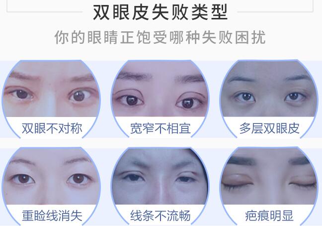 匡建国医生科普双眼皮