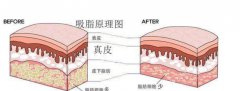 威塑吸脂原理是什么?果好吗?面部吸脂案例亲测,五星好评!