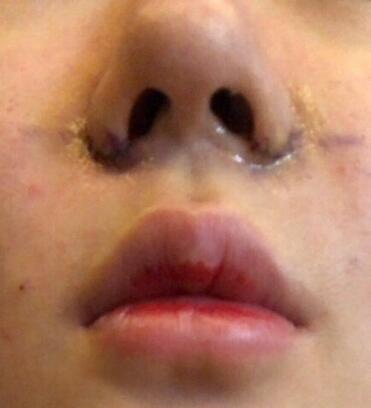 鼻翼缩小后果图对比