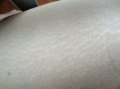 肥胖纹怎么消除？5种办法分享，还是较后一个靠谱！