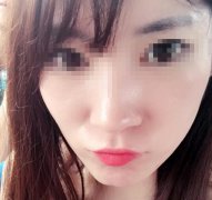 玻尿酸m唇刚打完图片曝光！丰唇手术前后对比图分享！