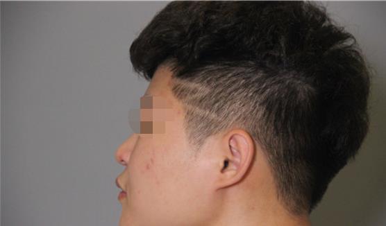 男人隆鼻有吗？爱美的权利不止是女孩子哟！来看我的隆鼻方案如何！