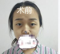 双眼皮失败的八种图片分享！内附亲身经历介绍哦！