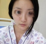 做隆鼻后水肿过程介绍！来看隆鼻术后一个月恢复怎么样吧
