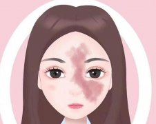 激光去胎记多少钱一次?术前术后注意事项有哪些?做者必看!