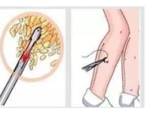 吸脂瘦腿002.jpg 吸脂瘦腿002.jpg