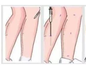 吸脂瘦腿001.jpg 吸脂瘦腿001.jpg