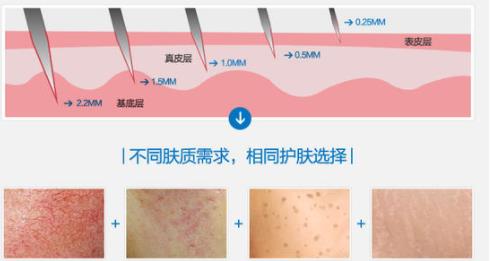 微针会造成毁容吗？会出现哪些副作用？如何选择合适的医院呢？
