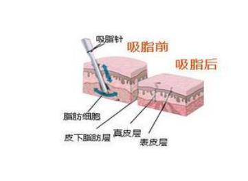 吸脂瘦腿005.jpg 吸脂瘦腿005.jpg