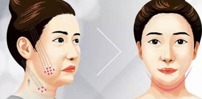 面部提升动漫5.jpg 面部提升动漫5.jpg