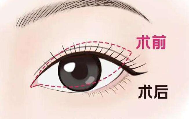 开眼角前后对比果图分享!前后差别太大了!快来看