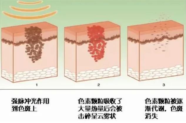 彩光祛痘果如何?彩光祛痘的价格一般在多少?祛痘案例分析!