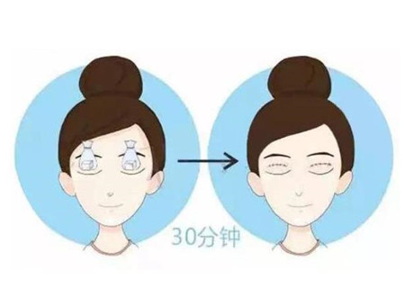 西京医院双眼皮失败修复怎么样?术后六个月恢复过程给大家参考一下