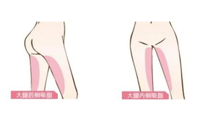 上海华美做大腿吸脂案例展示:告别粗壮大腿!纤细美腿你值得拥有!