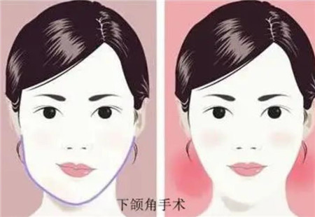 上海时光整形医院磨骨好不好?磨骨经验+新版价格发布!