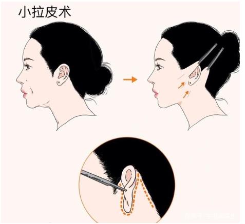 深圳北大医院做拉皮怎么样?拉皮后的图片分享!来看我的亲身经历分享吧