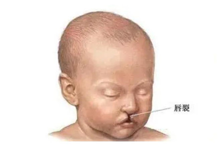 修复唇腭裂后应该如何护理