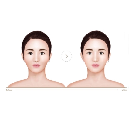 什么是颧骨整形手术?效果有哪些