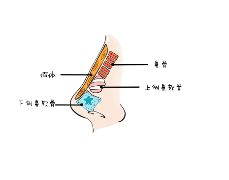鼻部整形手术的方法有哪些