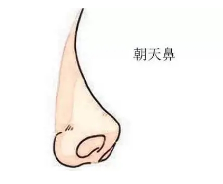 矫正朝天鼻的优势有哪些?痛不痛