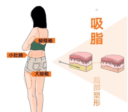 吸脂术有危险吗,有哪些危险