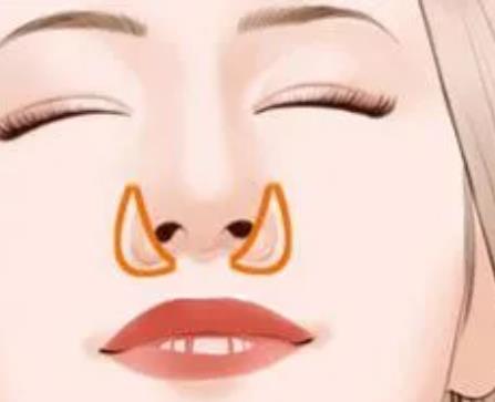 缩小鼻翼4.jpg