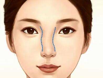 玻尿酸隆鼻前后对比怎么样？塌鼻梁逆袭高鼻梁太绝了