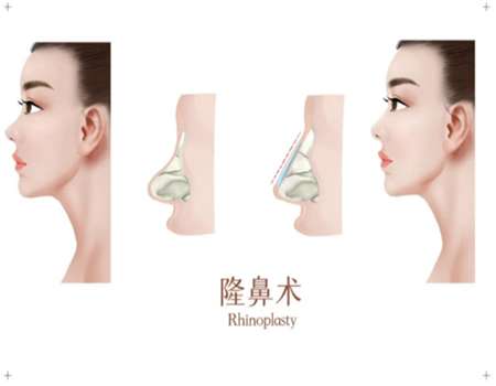 自体耳软骨隆鼻价格多少?隆鼻的注意事项查看