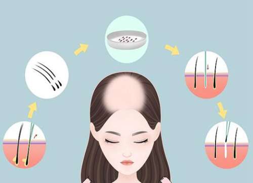 1000单位植发面积图怎么样?直观对比图+真人案例来啦
